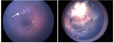 Retinoblastoma